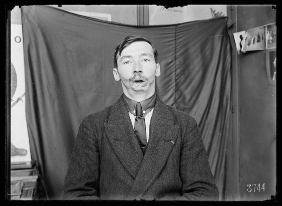 The image is a black and white photograph featuring an adult male standing in front of what appears to be a makeshift backdrop, which includes various items such as curtains or fabric panels. The man has a mustache, wears a dark overcoat with notched lapels, and beneath it, he seems to have on a dress suit jacket paired with a light-colored shirt and tie. His expression is neutral, and the photograph appears aged, suggesting that it may be from an earlier time period.

In terms of context provided by the alt text "Mutilated French soldier in Mrs. Ladd's studio before being fitted with artificial face," this image could potentially relate to historical subjects concerning prosthetics or facial reconstruction for injured soldiers during a war era. However, without further information about the specific background and identity details beyond what is visible in the photograph itself, it would be inappropriate to make assumptions about the individual depicted.

The number "3744" appears on one side of the image, which could possibly indicate an inventory or reference number for this particular photograph within a collection.